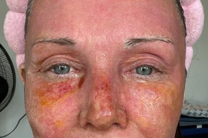 A mum claims a £4,250 CO2 laser treatment took 20 years off her face without surgery. Her viral TikTok posts show the stunning transformation and boost in confidence.