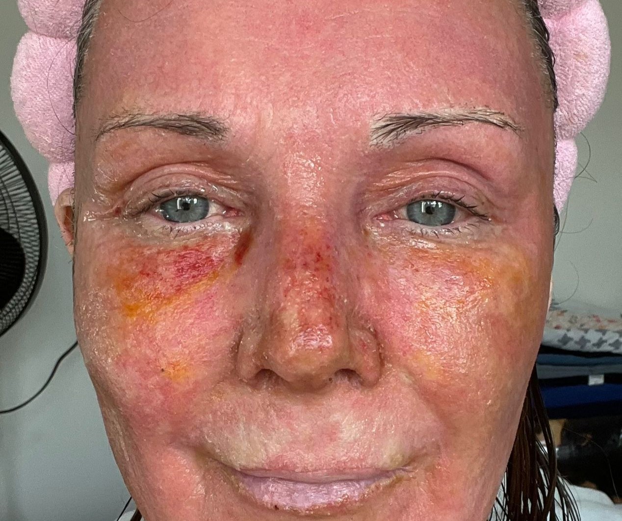 A mum claims a £4,250 CO2 laser treatment took 20 years off her face without surgery. Her viral TikTok posts show the stunning transformation and boost in confidence.