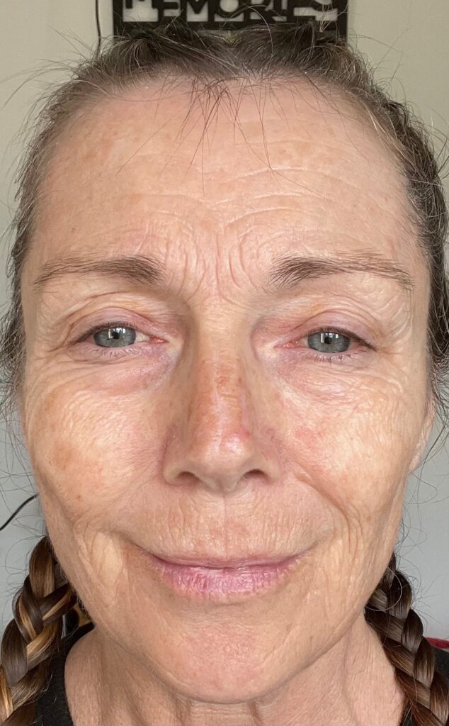 A mum claims a £4,250 CO2 laser treatment took 20 years off her face without surgery. Her viral TikTok posts show the stunning transformation and boost in confidence.