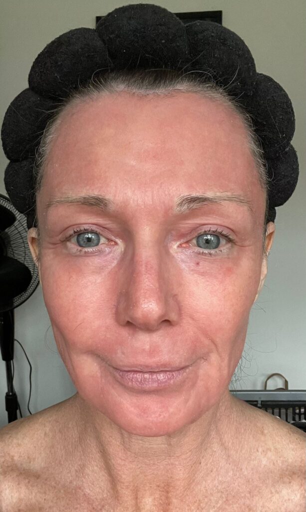 A mum claims a £4,250 CO2 laser treatment took 20 years off her face without surgery. Her viral TikTok posts show the stunning transformation and boost in confidence.