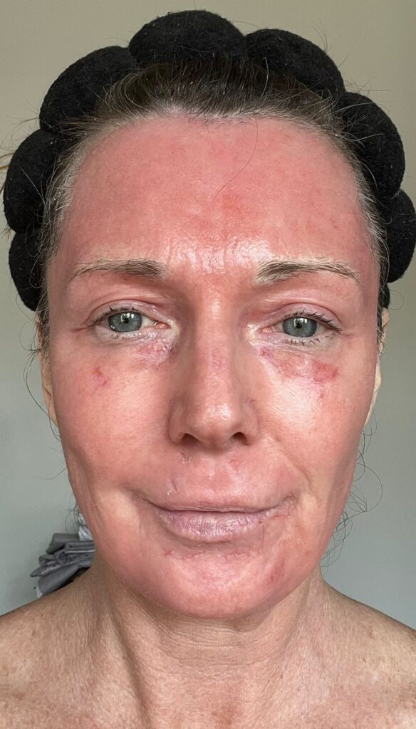 A mum claims a £4,250 CO2 laser treatment took 20 years off her face without surgery. Her viral TikTok posts show the stunning transformation and boost in confidence.