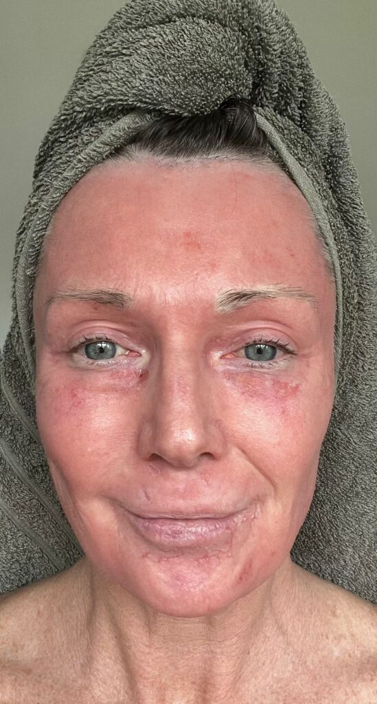 A mum claims a £4,250 CO2 laser treatment took 20 years off her face without surgery. Her viral TikTok posts show the stunning transformation and boost in confidence.