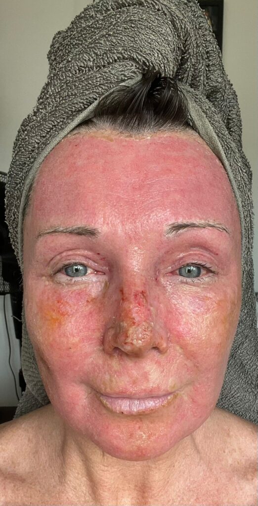 A mum claims a £4,250 CO2 laser treatment took 20 years off her face without surgery. Her viral TikTok posts show the stunning transformation and boost in confidence.