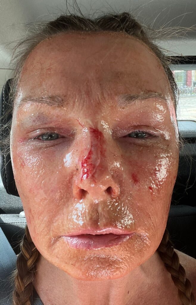 A mum claims a £4,250 CO2 laser treatment took 20 years off her face without surgery. Her viral TikTok posts show the stunning transformation and boost in confidence.