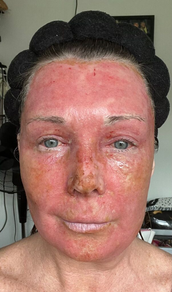 A mum claims a £4,250 CO2 laser treatment took 20 years off her face without surgery. Her viral TikTok posts show the stunning transformation and boost in confidence.