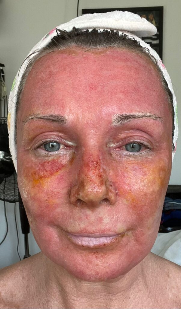 A mum claims a £4,250 CO2 laser treatment took 20 years off her face without surgery. Her viral TikTok posts show the stunning transformation and boost in confidence.