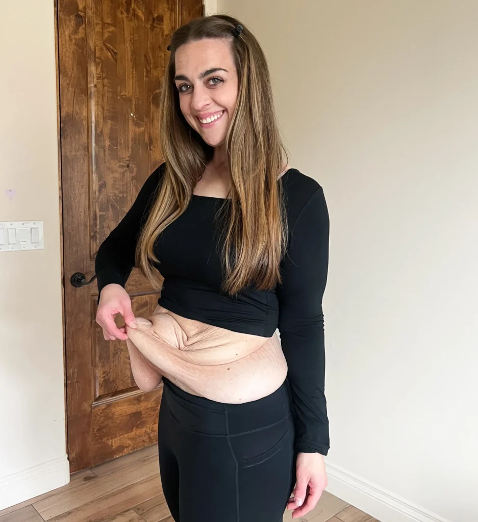 After losing 200lbs, Leah Mancuso spent $50k on skin removal surgery to match her transformation. Her emotional post-op reaction has inspired millions online.
