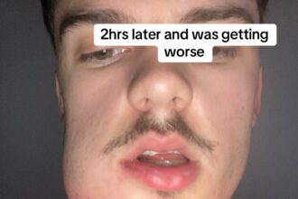 Man left looking like Quagmire from Family Guy after severe tooth infection caused his face to swell. Viral TikTok shows shocking transformation before abscess finally burst.