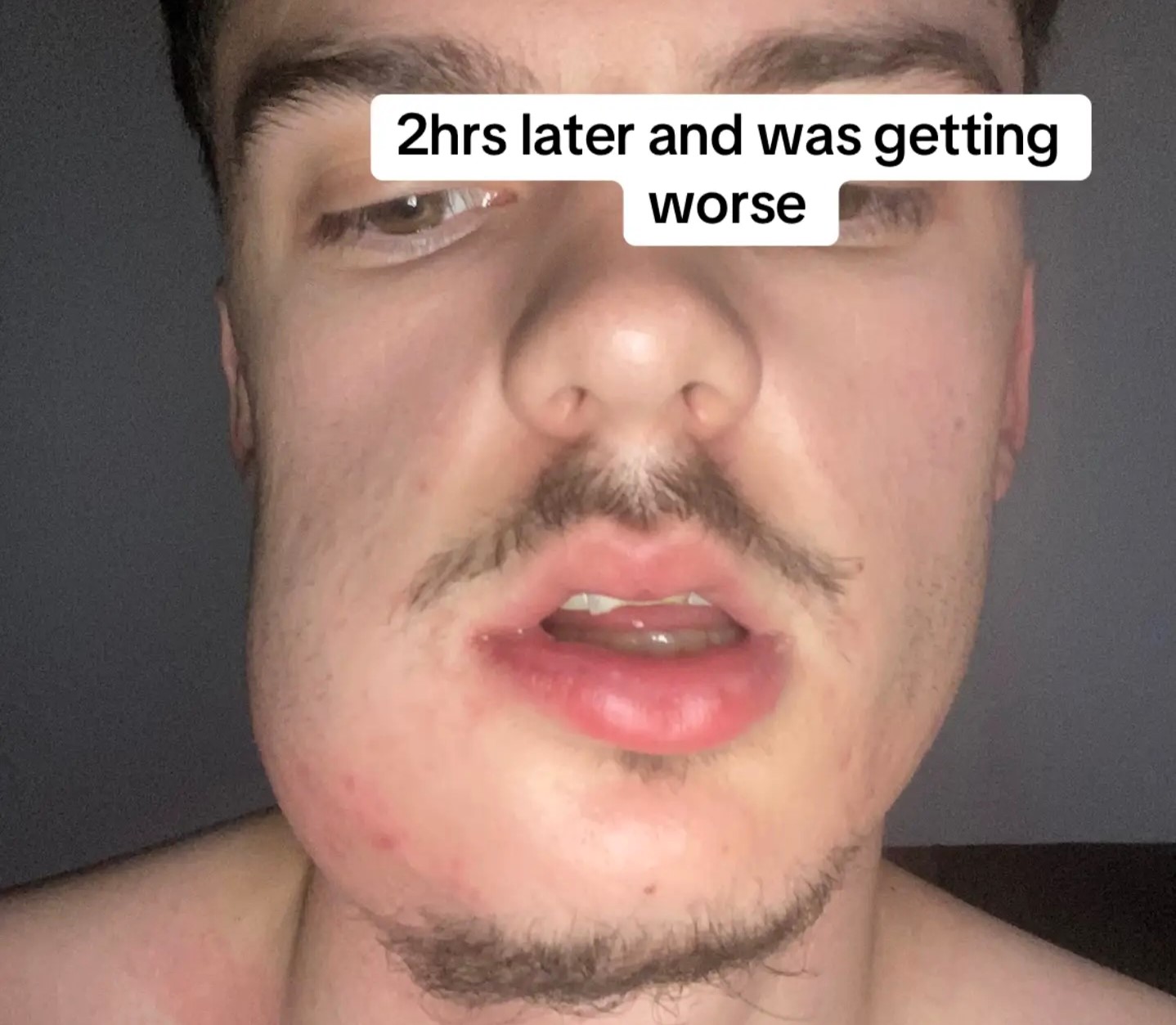 Man left looking like Quagmire from Family Guy after severe tooth infection caused his face to swell. Viral TikTok shows shocking transformation before abscess finally burst.