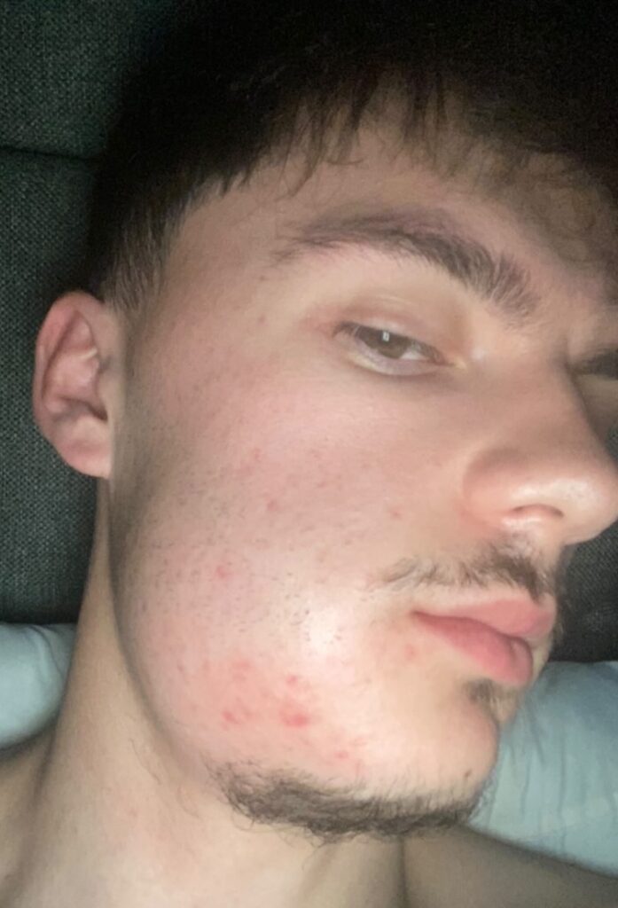 Man left looking like Quagmire from Family Guy after severe tooth infection caused his face to swell. Viral TikTok shows shocking transformation before abscess finally burst.