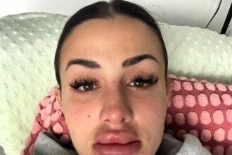 Woman’s lips triple in size after botched dissolving treatment - Thais Ledru shares shocking TikTok of swollen pout after filler mishap before thankfully returning to normal.