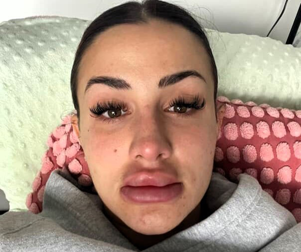 Woman’s lips triple in size after botched dissolving treatment - Thais Ledru shares shocking TikTok of swollen pout after filler mishap before thankfully returning to normal.