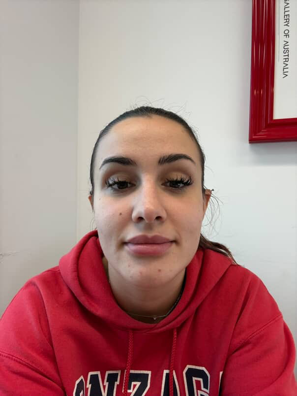 Woman’s lips triple in size after botched dissolving treatment - Thais Ledru shares shocking TikTok of swollen pout after filler mishap before thankfully returning to normal.