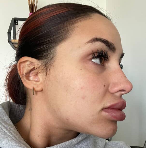 Woman’s lips triple in size after botched dissolving treatment - Thais Ledru shares shocking TikTok of swollen pout after filler mishap before thankfully returning to normal.