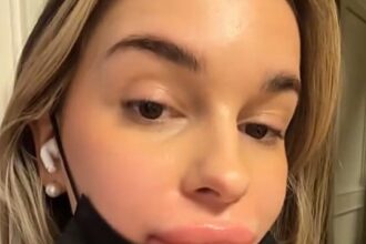 Woman’s lips balloon after botched fillers as practitioner bizarrely blames her period - 24-year-old Malene Mauer shares swollen ordeal and warns others to research clinics.