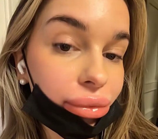 Woman’s lips balloon after botched fillers as practitioner bizarrely blames her period - 24-year-old Malene Mauer shares swollen ordeal and warns others to research clinics.