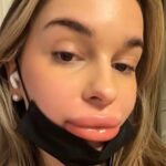 Woman’s lips balloon after botched fillers as practitioner bizarrely blames her period - 24-year-old Malene Mauer shares swollen ordeal and warns others to research clinics.