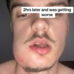 Man left looking like Quagmire from Family Guy after severe tooth infection caused his face to swell. Viral TikTok shows shocking transformation before abscess finally burst.
