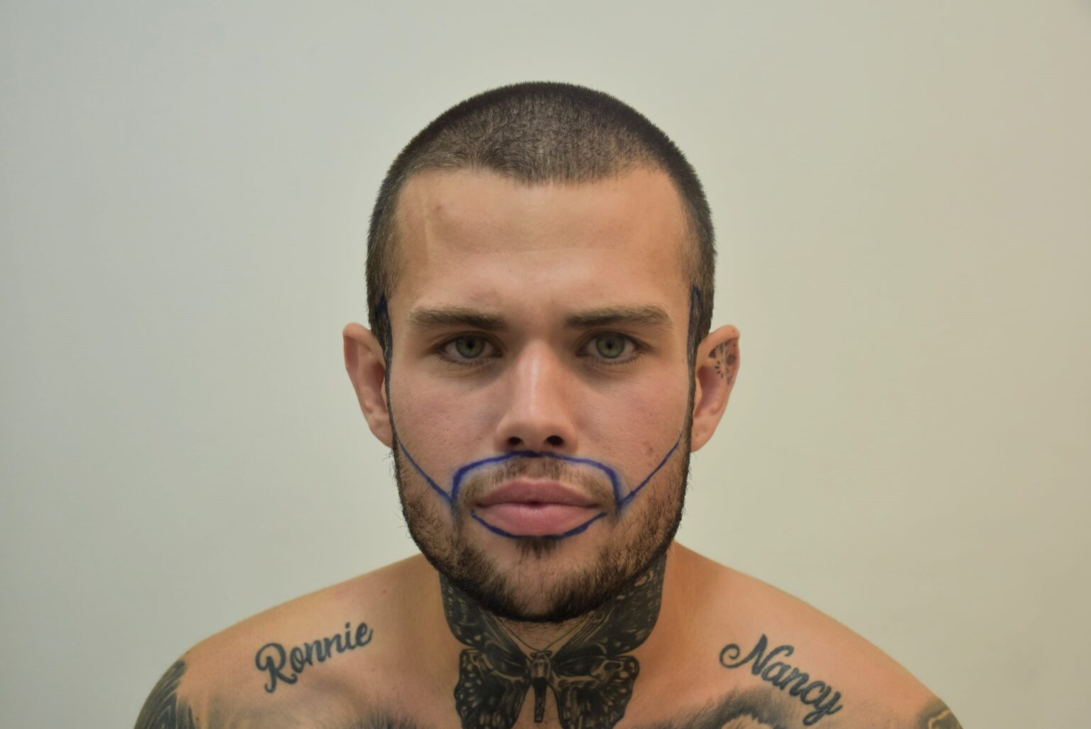 A man who flew to Turkey for a £2000 beard transplant says it was the best decision of his life after years of patchy growth left him insecure and struggling with confidence.