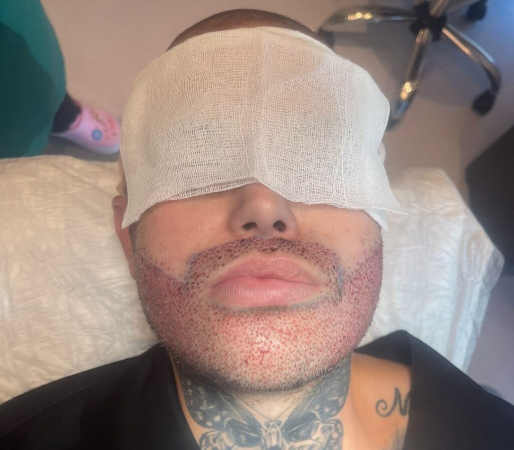 A man who flew to Turkey for a £2000 beard transplant says it was the best decision of his life after years of patchy growth left him insecure and struggling with confidence.