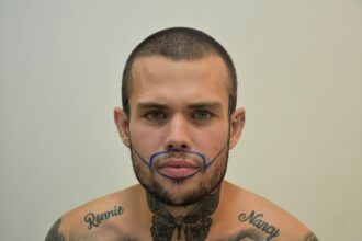 A man who flew to Turkey for a £2000 beard transplant says it was the best decision of his life after years of patchy growth left him insecure and struggling with confidence.