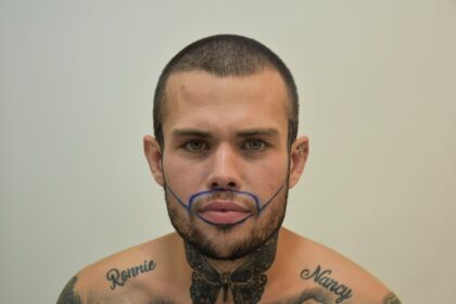 A man who flew to Turkey for a £2000 beard transplant says it was the best decision of his life after years of patchy growth left him insecure and struggling with confidence.