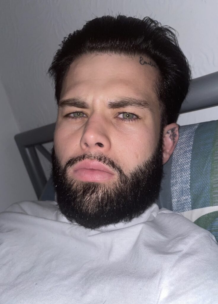 A man who flew to Turkey for a £2000 beard transplant says it was the best decision of his life after years of patchy growth left him insecure and struggling with confidence.