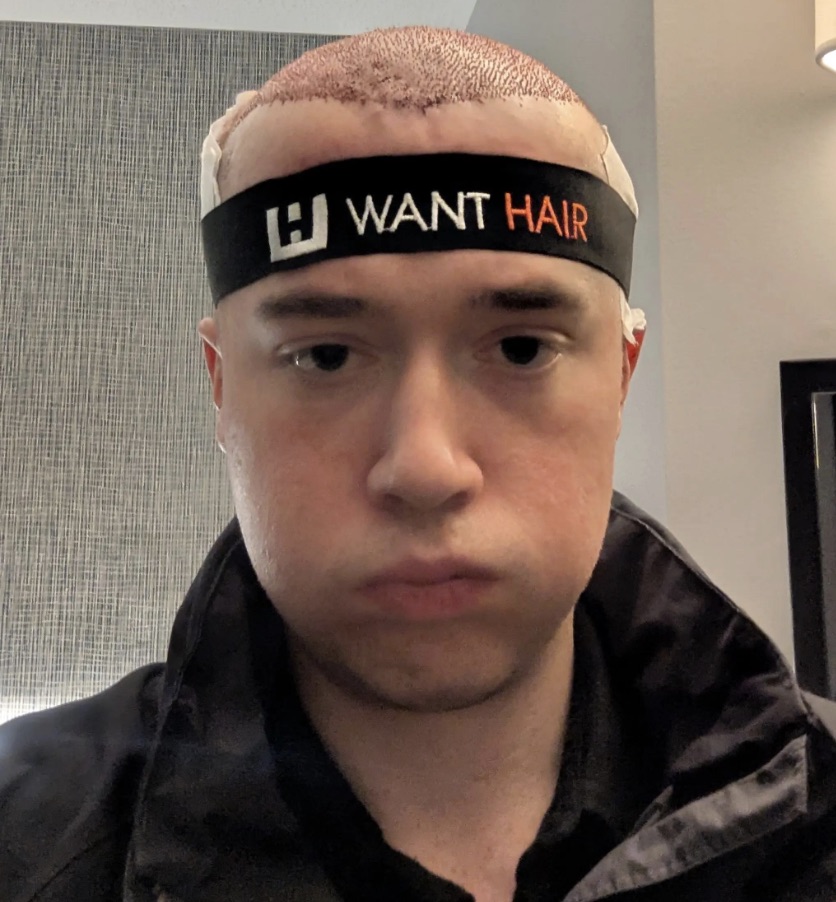 A man joked he looked like Megamind after severe swelling from a £3,500 hair transplant left his forehead ballooned and eyes bruised while he waited for long term results.