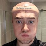A man joked he looked like Megamind after severe swelling from a £3,500 hair transplant left his forehead ballooned and eyes bruised while he waited for long term results.