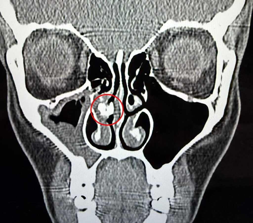 Argentine mum Candela Reybaud discovers a ball of sticky tape lodged in her nose for 35 years after lifelong breathing issues leading to its removal and an instant dramatic improvement.