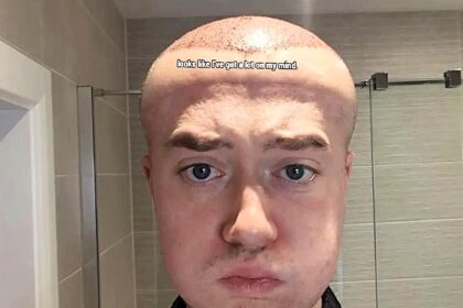 A man joked he looked like Megamind after severe swelling from a £3,500 hair transplant left his forehead ballooned and eyes bruised while he waited for long term results.