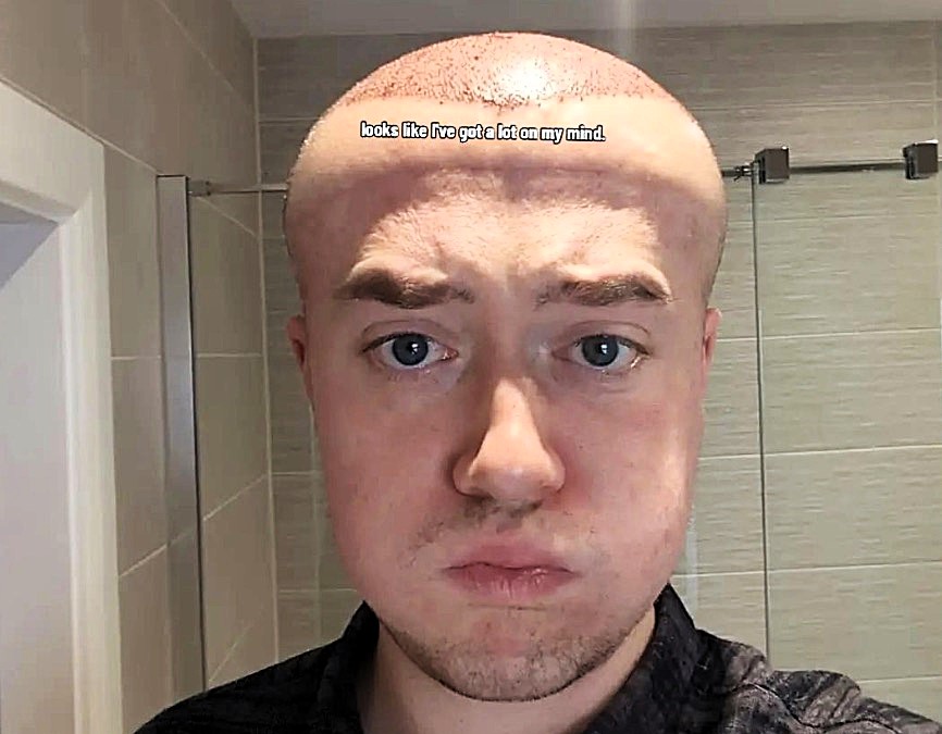 A man joked he looked like Megamind after severe swelling from a £3,500 hair transplant left his forehead ballooned and eyes bruised while he waited for long term results.