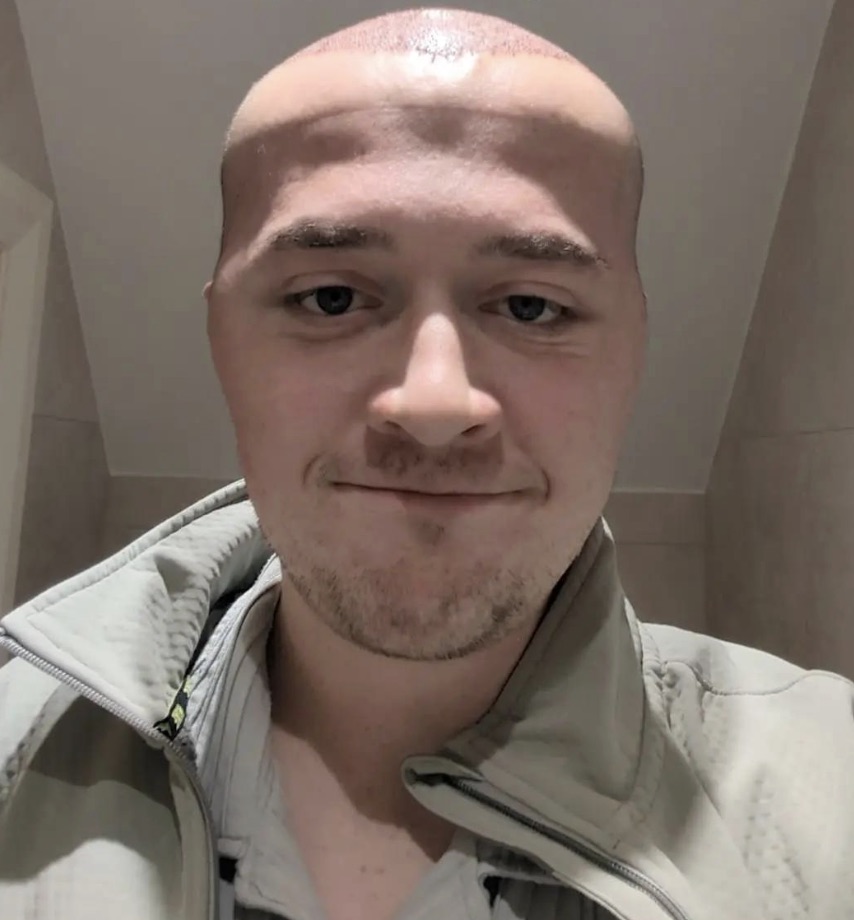 A man joked he looked like Megamind after severe swelling from a £3,500 hair transplant left his forehead ballooned and eyes bruised while he waited for long term results.