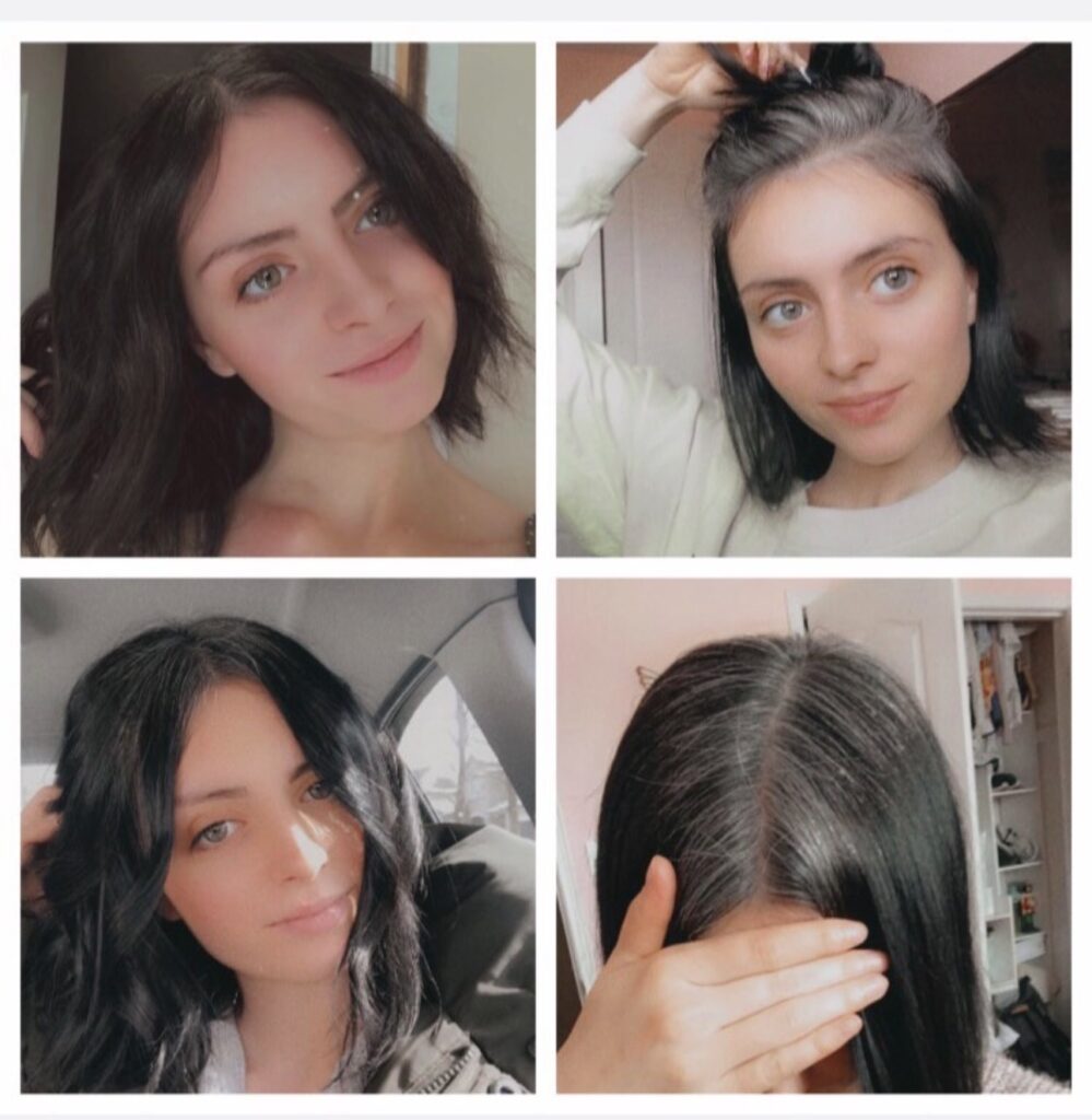 A woman who went fully grey in her teens is finally embracing her natural silver hair after years of bullying, inspiring millions with her dye free journey and message of self love.