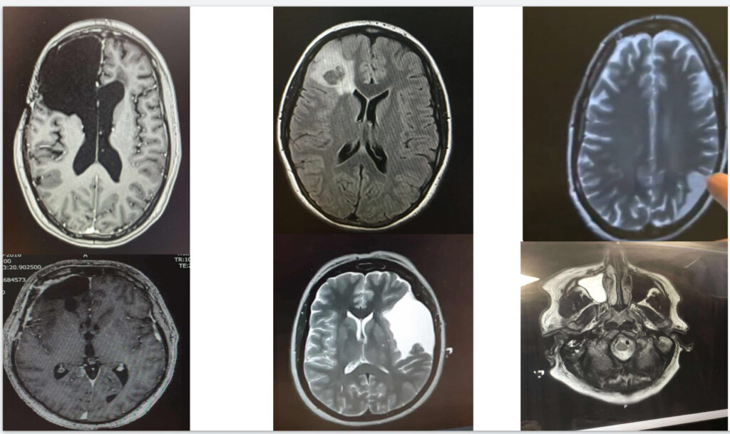 Cancer survivor transforms brain scans into colourful paintings turning illness into art as patient stories become emotional tributes celebrating healing resilience and the NHS.