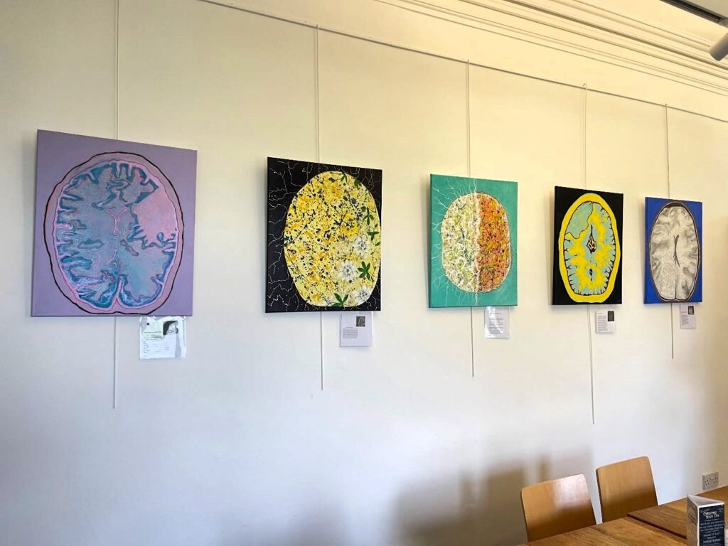 Cancer survivor transforms brain scans into colourful paintings turning illness into art as patient stories become emotional tributes celebrating healing resilience and the NHS.