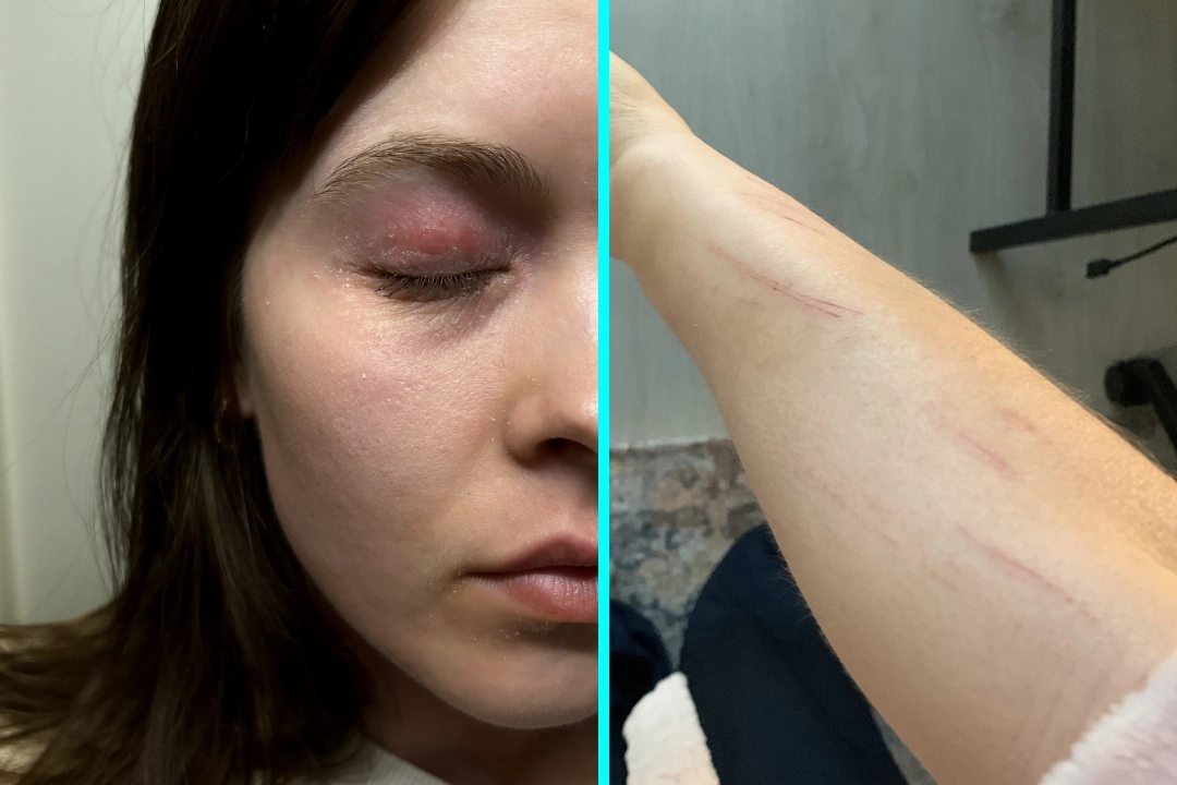 Student Annika Tammi, 25, cured her lifelong eczema by cutting out sugar, wheat and ultra-processed foods after discovering her skin problems stemmed from gut imbalance issues.