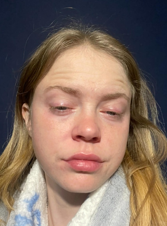 Woman with rare cold urticaria says winter leaves her terrified to go outside as freezing air triggers painful hives, swelling and burning reactions every day in winter