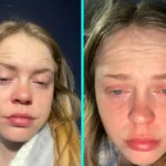 Woman with rare cold urticaria says winter leaves her terrified to go outside as freezing air triggers painful hives, swelling and burning reactions every day in winter