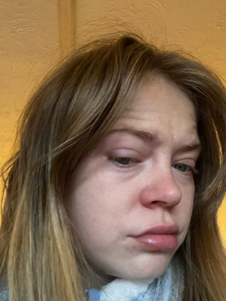 Woman with rare cold urticaria says winter leaves her terrified to go outside as freezing air triggers painful hives, swelling and burning reactions every day in winter