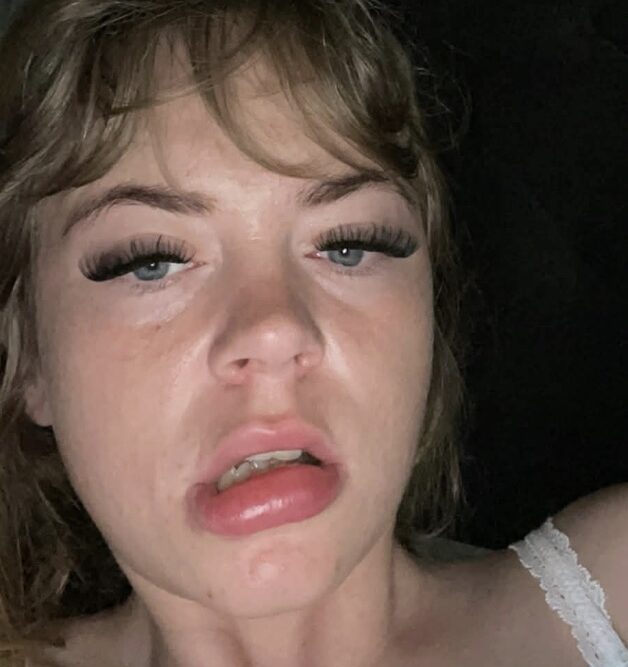 Woman with rare cold urticaria says winter leaves her terrified to go outside as freezing air triggers painful hives, swelling and burning reactions every day in winter