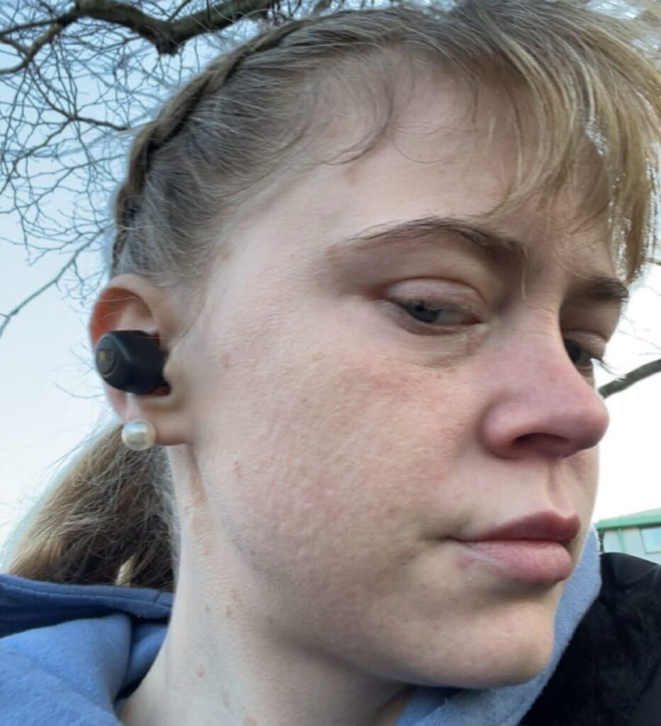 Woman with rare cold urticaria says winter leaves her terrified to go outside as freezing air triggers painful hives, swelling and burning reactions every day in winter