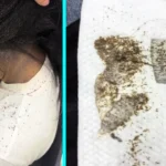 Sydney lice technician forced to shave client's head after discovering millions of nit eggs layered so thickly they were impossible to comb out without severe pain.