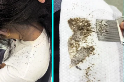 Sydney lice technician forced to shave client's head after discovering millions of nit eggs layered so thickly they were impossible to comb out without severe pain.