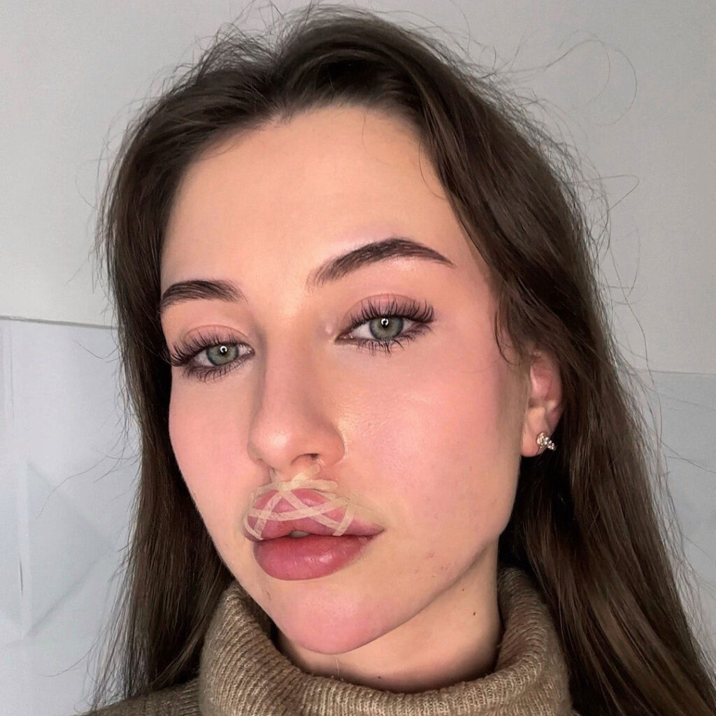 Woman left shocked after clinic taped up her lips following filler procedure. Kseniia Krainia's practitioner used new technique designed to hold filler in correct position.