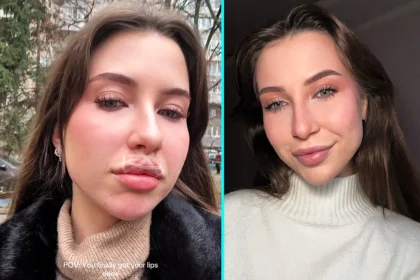Woman left shocked after clinic taped up her lips following filler procedure. Kseniia Krainia's practitioner used new technique designed to hold filler in correct position.