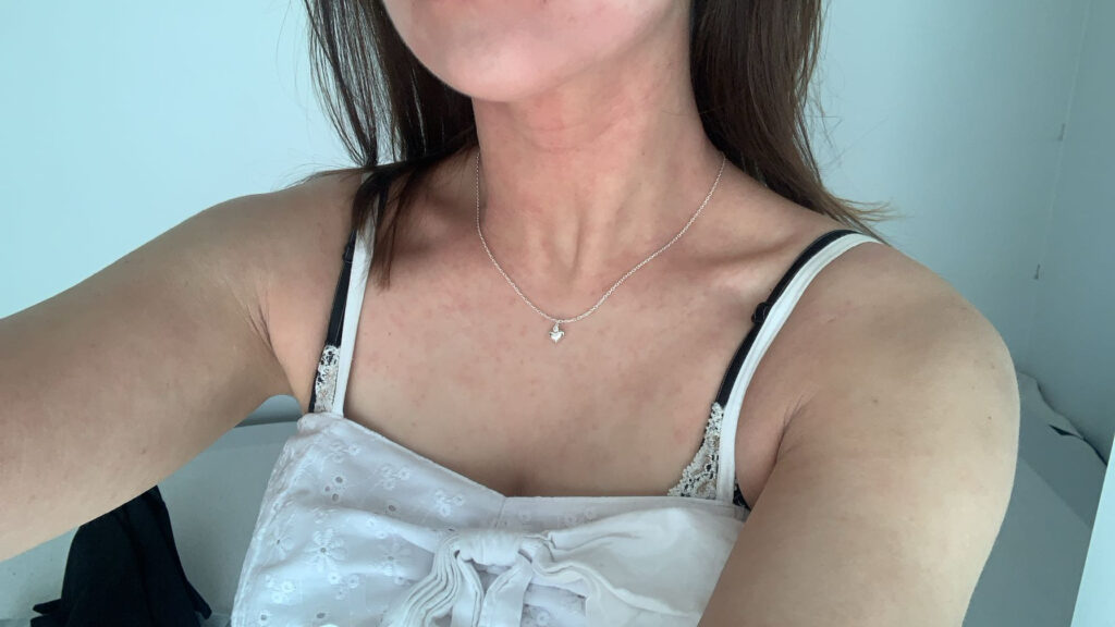 Student Annika Tammi, 25, cured her lifelong eczema by cutting out sugar, wheat and ultra-processed foods after discovering her skin problems stemmed from gut imbalance issues.