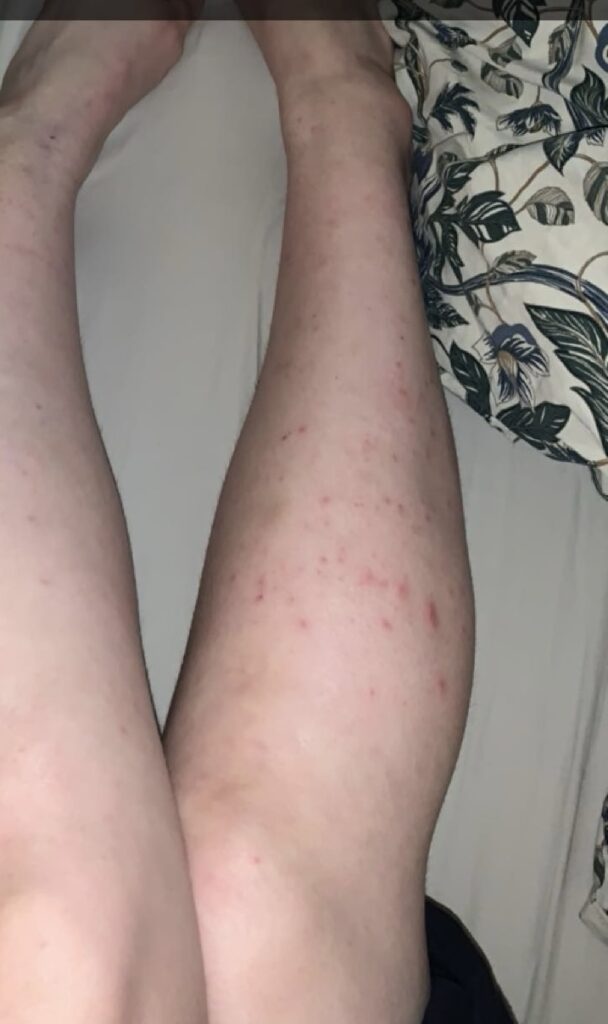 Student Annika Tammi, 25, cured her lifelong eczema by cutting out sugar, wheat and ultra-processed foods after discovering her skin problems stemmed from gut imbalance issues.