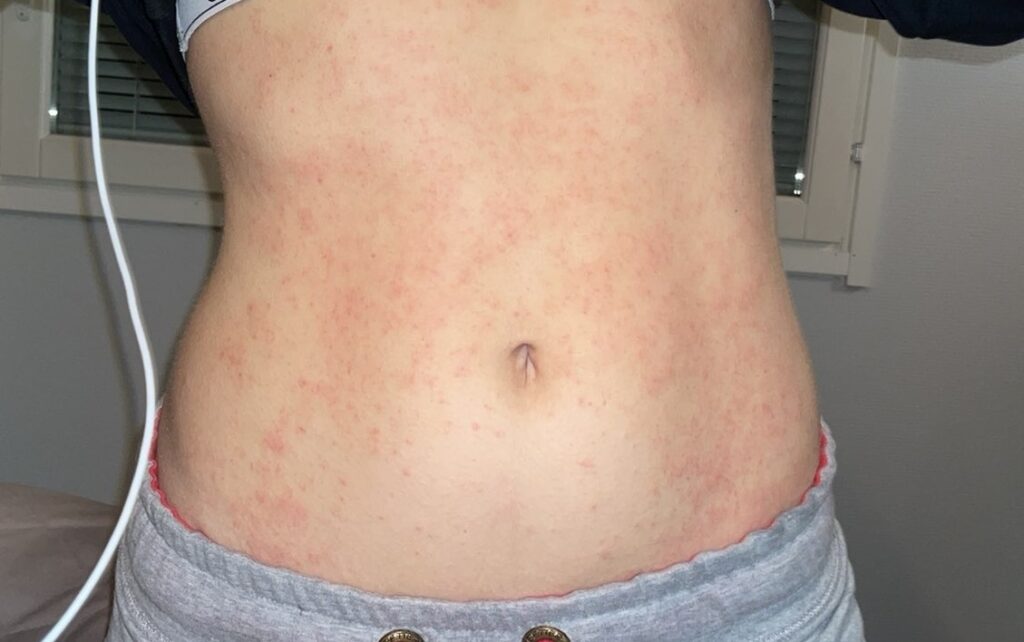 Student Annika Tammi, 25, cured her lifelong eczema by cutting out sugar, wheat and ultra-processed foods after discovering her skin problems stemmed from gut imbalance issues.