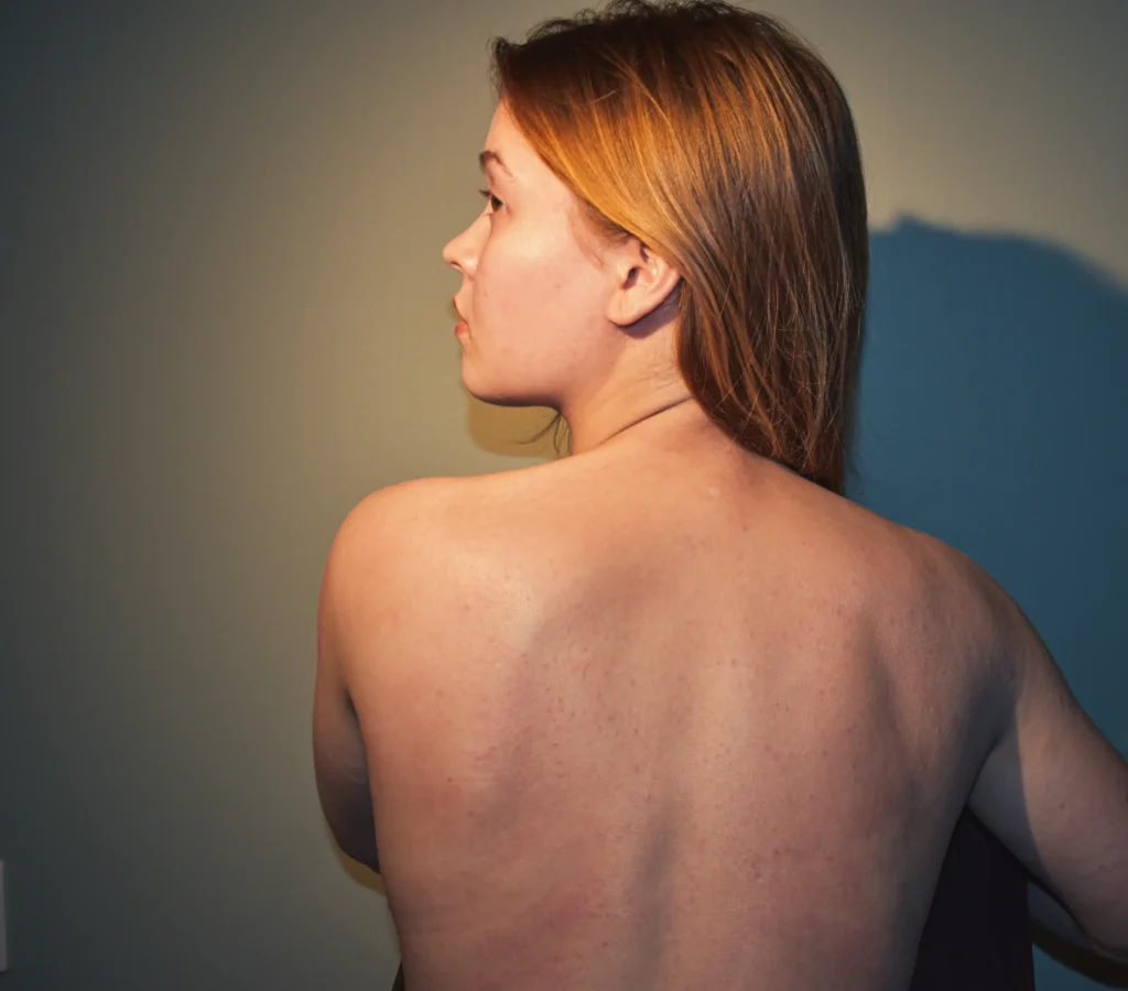 Student Annika Tammi, 25, cured her lifelong eczema by cutting out sugar, wheat and ultra-processed foods after discovering her skin problems stemmed from gut imbalance issues.